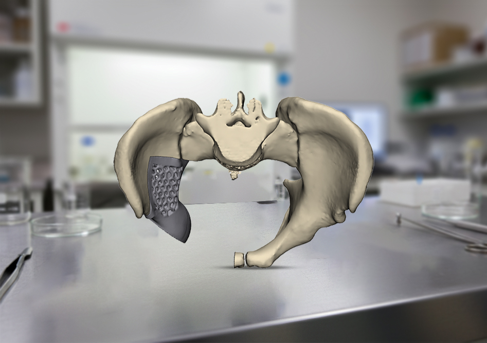 How Patient-Specific Implants Are Redefining Modern Surgical Precision

Patient-specific implants ar...