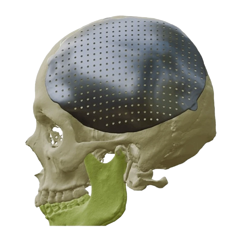3D printed cranial implant designed for skull reconstruction and neurosurgery applications