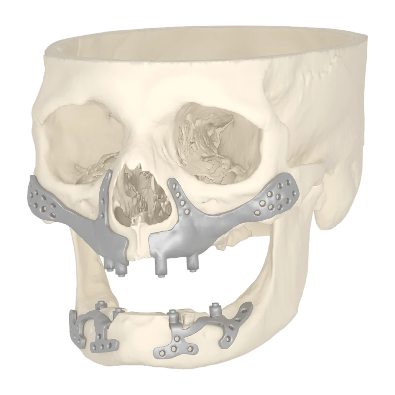 3D anatomical skull model used for oral and maxillofacial reconstruction planning