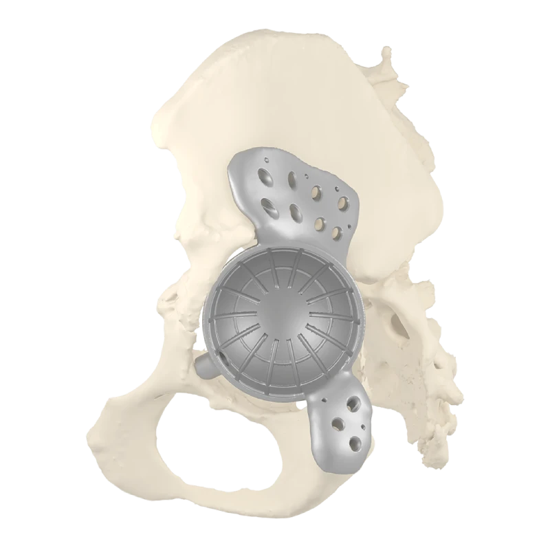 Patient-specific pelvic implant developed for complex orthopedic reconstruction surgery