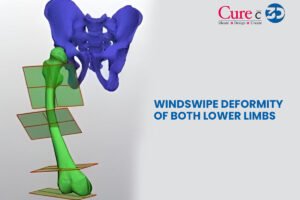 Windswipe Deformity of Both Lower Limbs