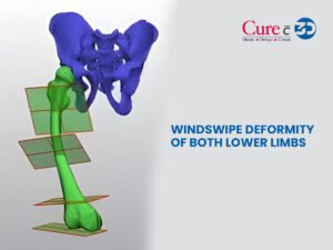 Read more about the article Windswipe Deformity of Both Lower Limbs