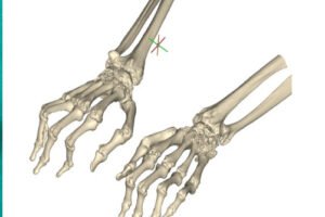 Proximal Interphalangeal Joint Arthroplasty