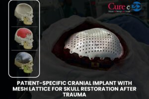 3D Printed Custom Titanium Cranial Implant for Cranial Reconstruction