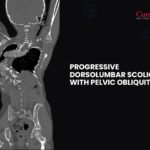 Progressive Dorsolumbar Scoliosis with Pelvic Obliquity