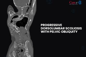 Progressive Dorsolumbar Scoliosis with Pelvic Obliquity