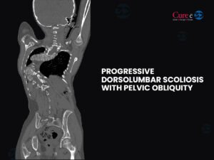 Read more about the article Progressive Dorsolumbar Scoliosis with Pelvic Obliquity