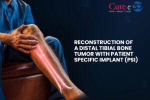 Reconstruction of a Distal Tibial Bone Tumor with Patient-Specific Implant (PSI)