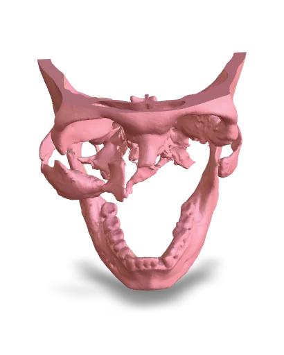 Customized Metal Implants making 3D Printing technology, cure with 3d, curewith3d